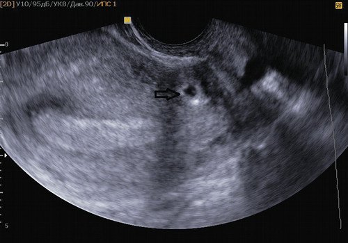 Беременность в рубце - стрелкой помечено плодное яйцо, соответствующее 3-4 неделям беременности, в области рубца после кесарева сечения