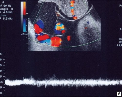 ЦДК поверхностных сосудов опухоли плаценты, формирующих артериовенозный шунт, венозный спектр кровотока при допплерометрии