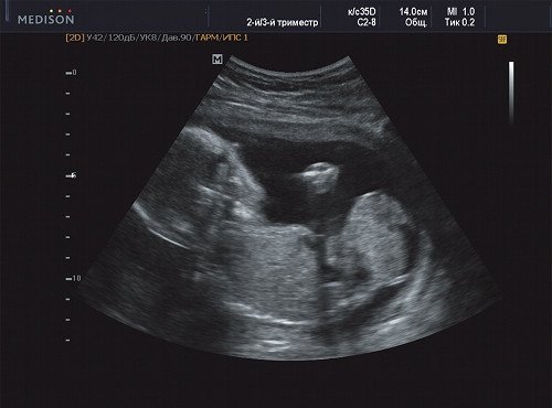 Беременность 20 недель, справа - голова плода, слева - опухоль