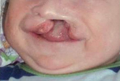 Фото - расщелина лица у ребенка с синдромом ЕЕС в 3 месяца