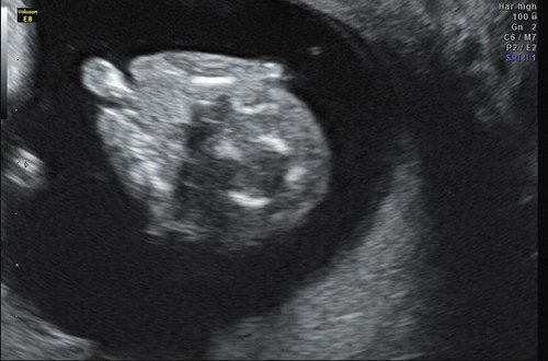 Эхограмма - расщелина лица (12,6 недели беременности)