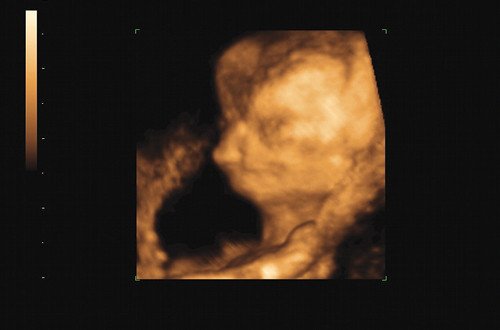 Эхограмма - расщелина лица (12,6 недели беременности)