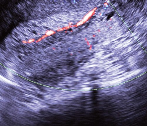 Эхограмма - движение крови в полости матки на фоне гиперплазии эндометрия, режим ЦДК