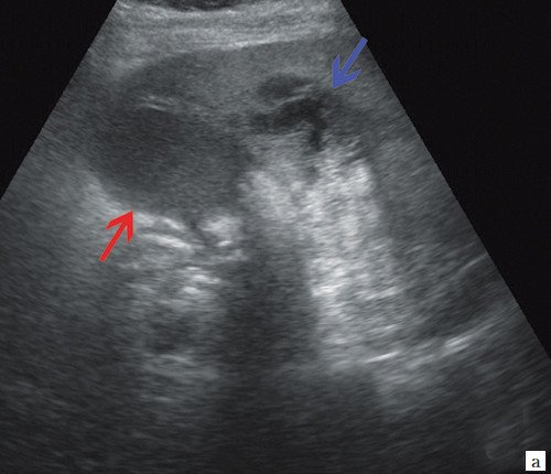 Эхограмма - желчный пузырь с двойным контуром (красная стрелка) и паравезикальное жидкостное образование (синяя стрелка)