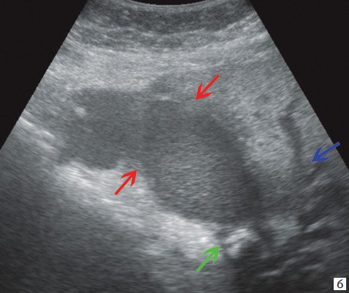 Эхограмма - увеличенный желчный пузырь, заполненный густой желчью (красные стрелки), неподвижный конкремент в шейке желчного пузыря (зеленая стрелка), расширенные внутрипеченочные протоки (синяя стрелка)