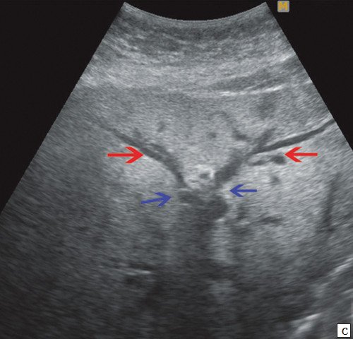 Эхограмма - прерывание визуализации протоков в области слияния долевых протоков печени (синие стрелки), долевые протоки (красные стрелки)