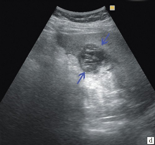 Эхограмма - паравезикальные образования жидкостного характера, с большим количеством перегородок внутри и густой жидкостью (синие стрелки)