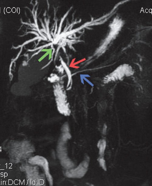 МРТ при опухоли Клацкина - ОЖП (красная стрелка), общий панкреатический проток (синяя стрелка), внутрипеченочные протоки в области бифуркации (зеленая стрелка) - обрыв в проекции слияния