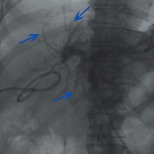Холангиография - опухоль ворот печени, контрастирование протоков левой доли печени (синие стрелки)