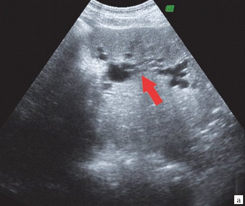 Эхограмма - расширение внутрипеченочных протоков (стрелка)