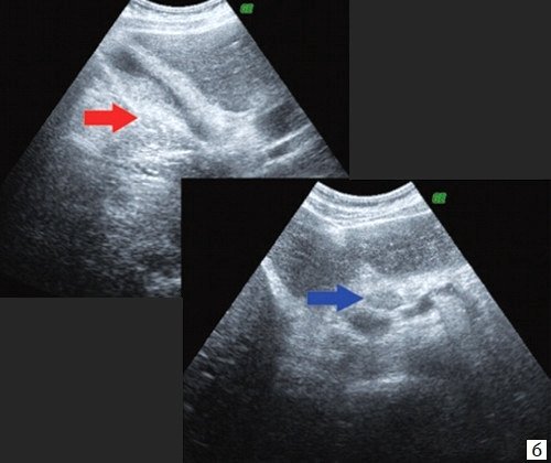 Эхограмма - спавшийся желчный пузырь (красная стрелка), парапортальный лимфоузел (синяя стрелка)