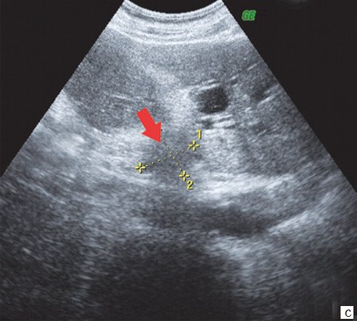 Эхограмма - гипоэхогенное образование 28 х 26 мм с неровными нечеткими контурами в воротах печени (стрелка)