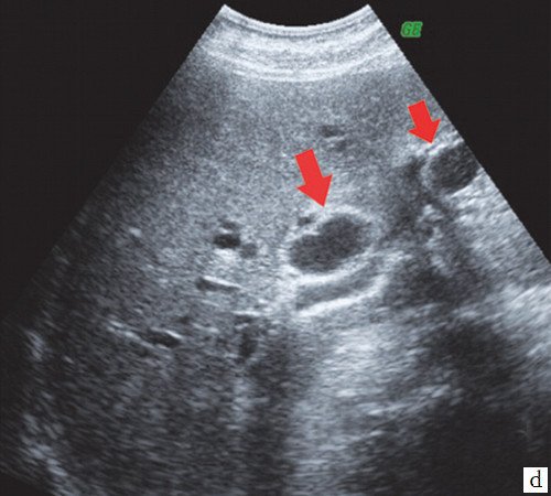 Эхограмма - расширение правого долевого и левого сегментарного протоков (стрелки)