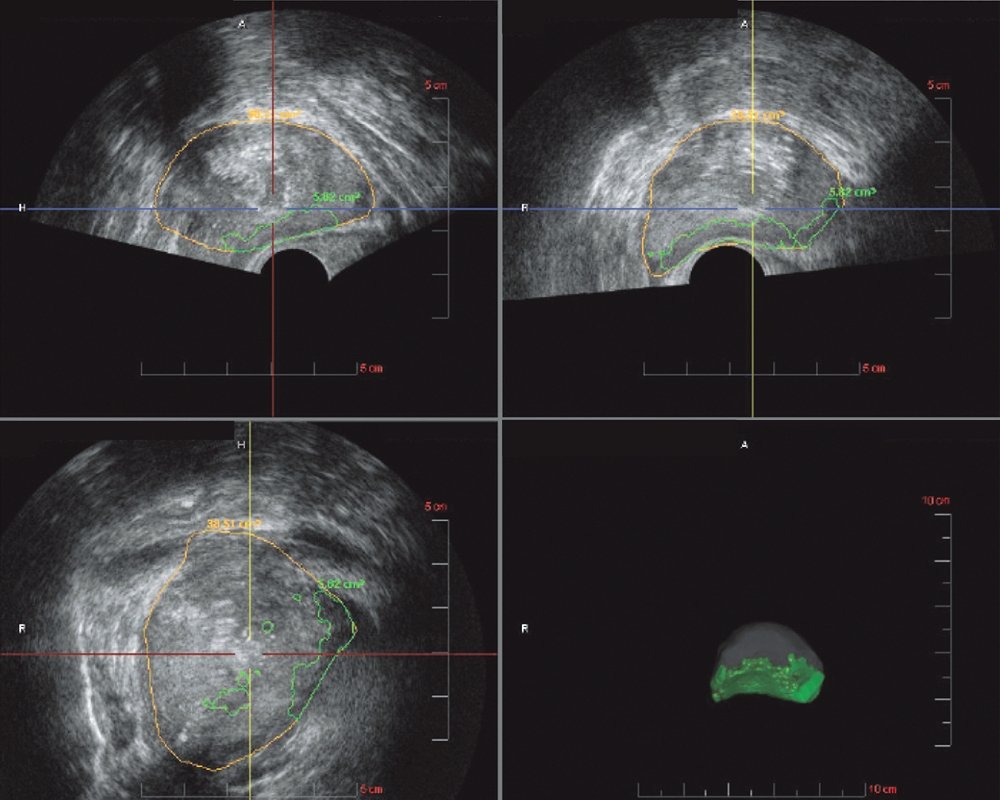Предстательная железа в 3 проекциях и 3D-модель, на которой зеленым цветом обозначена ткань (подозрение на рак простаты), полученная при гистосканировании