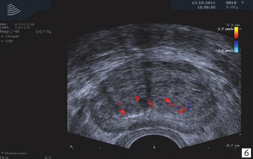 ТРУЗИ - допплерография
