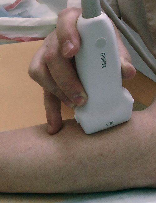 Фото - техника фиксации датчика при сономиографии и проведении ARFI