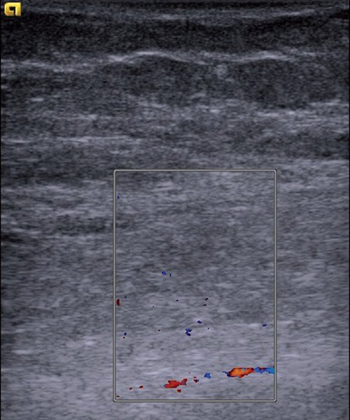 Эхограмма мышцы в прежней точке сканирования после нагрузки - кровоток не изменился, остается скудным