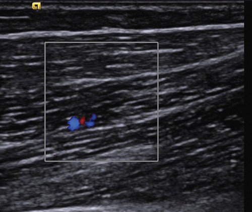 Эхограмма здоровой двуглавой мышцы плеча - мышечная ткань гипоэхогенна, однородна, прослеживаются параллельные эхопозитивные линейные структуры - прослойки соединительной ткани, кровоток в состоянии покоя слабый