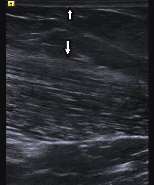 Эхограмма мышцы женщины - слой подкожной жировой клетчатки (границы показаны стрелками) выражен, в мышце эндо- и перимизиальные прослойки тонкие