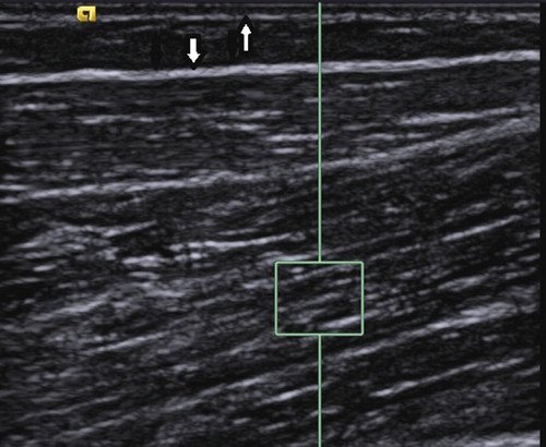 Эхограмма мышцы мужчины - слой подкожной жировой клетчатки (границы показаны стрелками) выражен значительно меньше, четко прослеживаются соединительнотканные прослойки