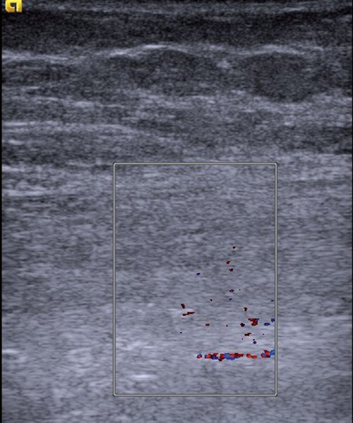Эхограмма мышцы при тяжелой химио- и кортикостероидной нейромиопатии - нормальная текстура мышцы утрачена, кровоток минимальный