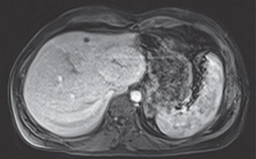 МРТ печени с контрастным веществом примавист - артериальная фаза