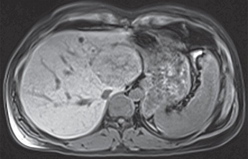 МРТ печени - Т1ви, натив
