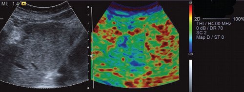 Элатография с ручной компрессией (режим цветового кодирования) - объемное образование в левой доле печени (мягкой консистенции с жесткими включениями)
