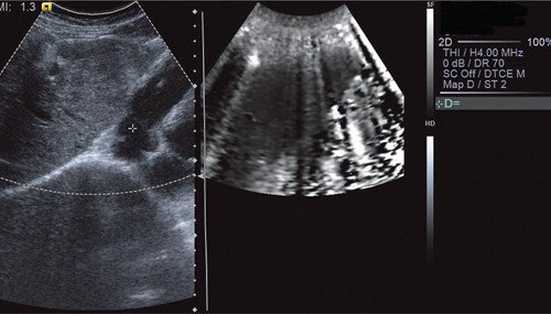 Эластография с методикой ARFI - объемное образование в левой доле печени (по периферии - мягкой консистенции, в центральных отделах - жесткой консистенции)
