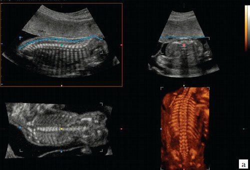 УЗИ позвоночника плода (3D) с применением Auto-Contour