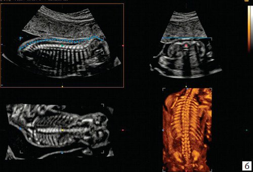 УЗИ позвоночника плода (3D) с применением Auto-Contour и HDVI