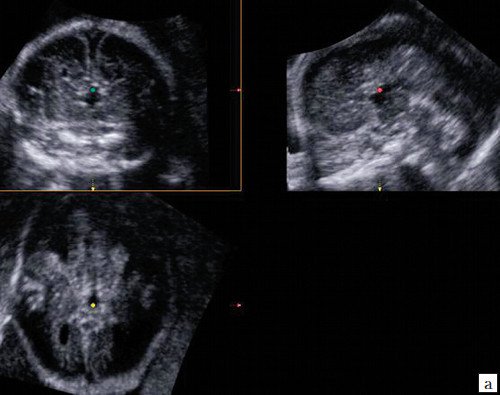 УЗИ головного мозга плода - мультипланарный 3D-режим