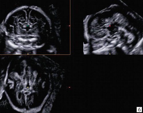 УЗИ головного мозга плода - мультипланарный 3D-режим с HDVI