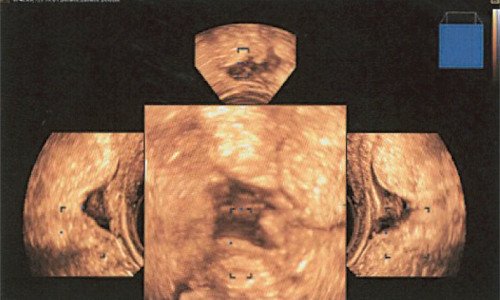 3D эхограмма очага наружного эндометриоза в продольном мышечном слое прямой кишки (Mirror View)