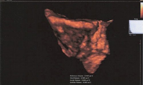 3D эхограмма узла наружного эндометриоза в продольном мышечном слое прямой кишки (VOCAL)