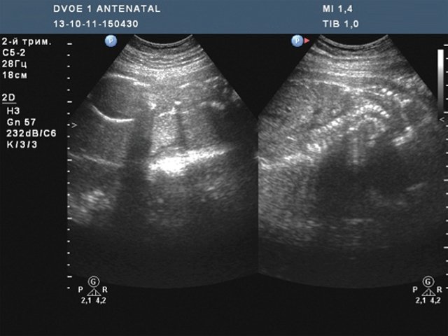Аномальный мышечный тонус плода - антенатальная гибель одного из близнецов (двухплодная беременность 28 нед)