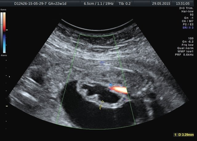 Эхограмма - истончение паренхимы правой почки плода с отсутствием кровотока в режиме ЦДК