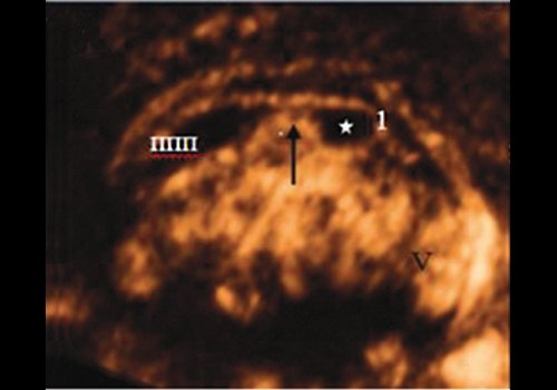 Эхограмма - прикрепление свода мозга плода к мозолистому телу - кпереди от перешейка мозолистого тела