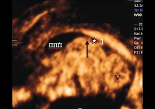 Эхограмма - прикрепление свода мозга плода к мозолистому телу - на уровне перешейка