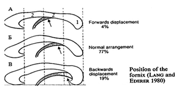 Схематическая картина уровней прикрепления свода мозга к мозолистому телу и их встречаемость (%)