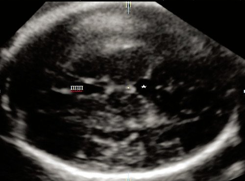 Аксиальный срез головного мозга плода, показывающий дополнительное межполушарное жидкостное образование (звездочка)