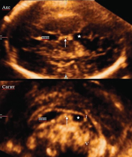 Аксиальный и среднесагиттальный срез 3D реконструкции головного мозга плода - анатомия и расположение жидкостного образования (полость Верге)