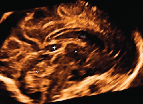 Объемная реконструкция среднесагиттального среза головного мозга плода - визуализируется дополнительная жидкостная полость (полость промежуточного паруса)