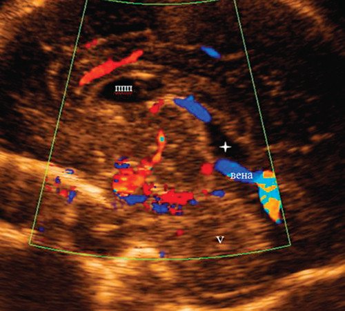 Среднесагиттальный срез головного мозга плода с цветовым допплеровским картированием - внутренняя мозговая вена проходит по нижней границе диагностированной кистозной полости (полость промежуточного паруса)