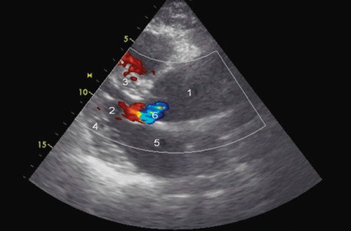 Эхокардиограмма больного Ж. Режим ЦДК. Парастернальная позиция по длинной оси. 1 - аорта, 2 - левый желудочек, 3 - межжелудочковая перегородка, 4 - задняя стенка левого желудочка, 5 - левое предсердие, 6 - регургитация на аортальном клапане
