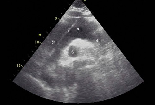 Эхокардиограмма больного Ж. Супрастернальная позиция. 1 - отслоенная интима аорты, 2 - восходящий отдел аорты, 3 - дуга аорты, 4 - нисходящий отдел аорты, 5 - правая ветвь легочной артерии