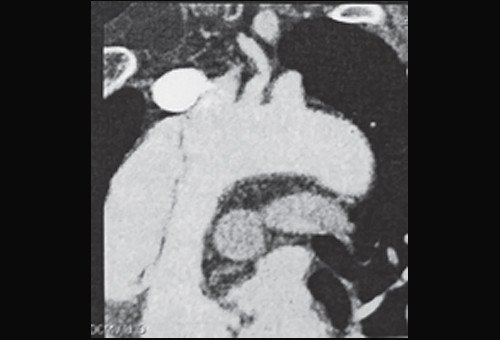 Мультиспиральная компьютерная томограмма больного Ж. Восходящий отдел и дуга аорты с визуализируемой отслоенной интимой
