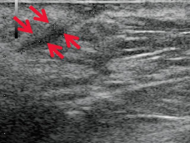 УЗИ мягких тканей промежности (В-режим) - через 14 дней после оперативного вмешательства, свищевой ход визуализируется нечетко (стрелки)