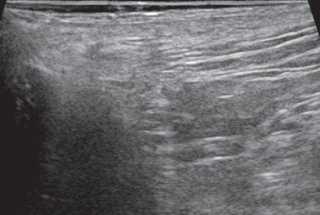 УЗИ мягких тканей промежности (В-режим) - через 3 месяца после оперативного вмешательства, жидкостное образование со свищевым ходом в подкожно-жировой клетчатке четко не визуализируется