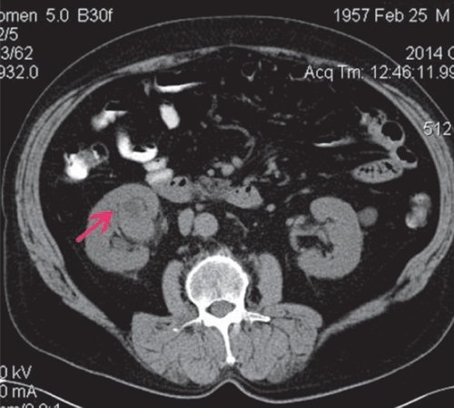 КТ почки (нативная фаза) - в нижне-средних отделах ЧЛС справа мягкотканное объемное образование, деформирующее ЧЛС